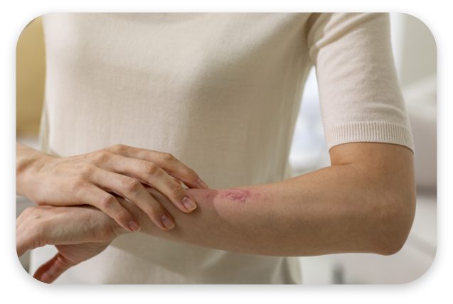 대상포진 대표 이미지